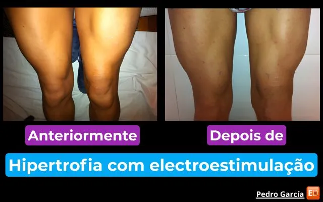 Electroestimulação como solução para a atrofia muscular